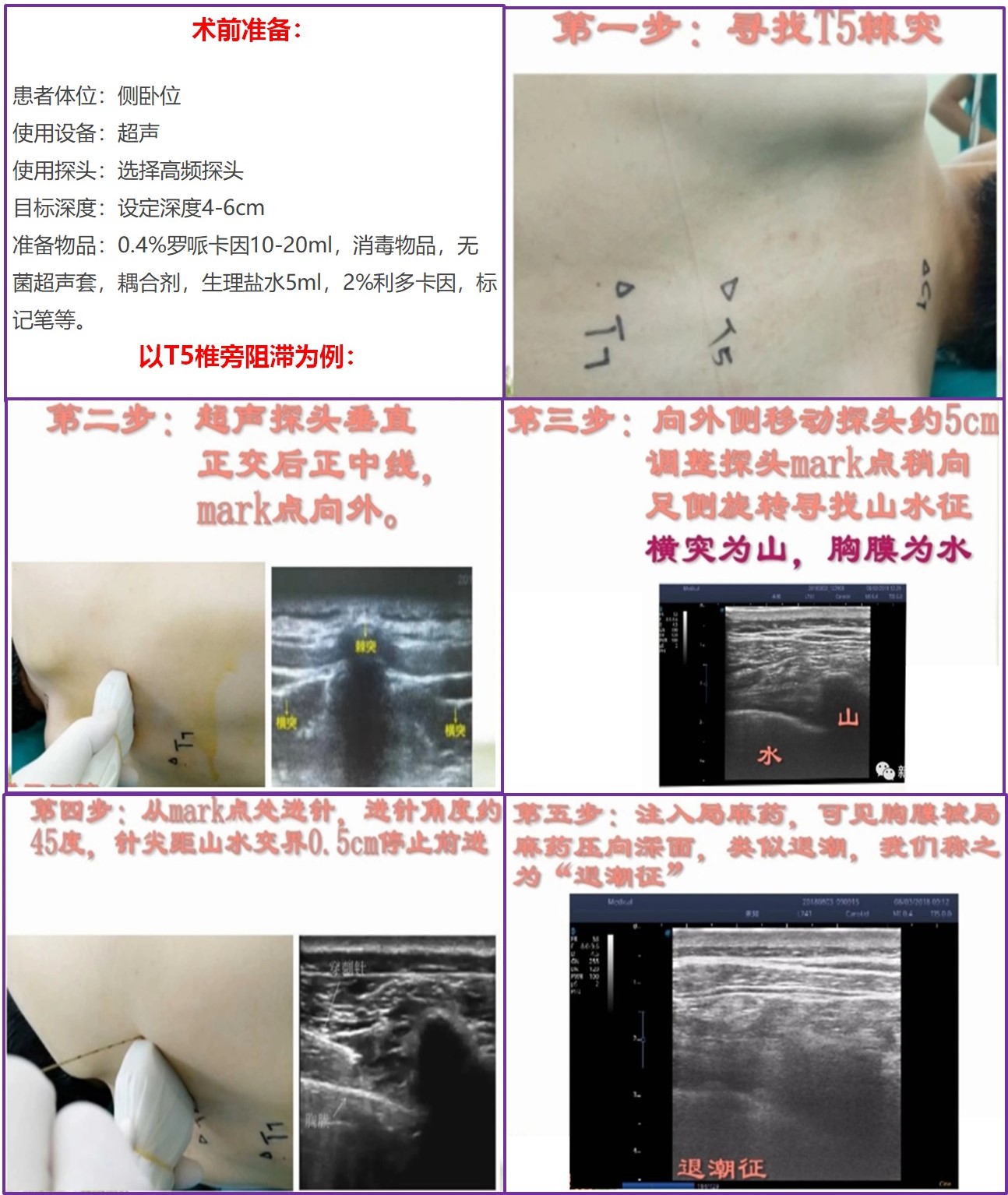 超声引导下T5椎旁阻滞操作步骤